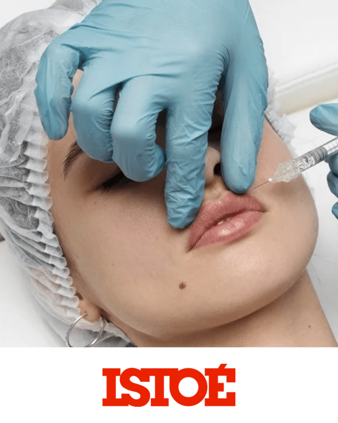 Preechimento labial: como é feito e o que acontece quando dá errado